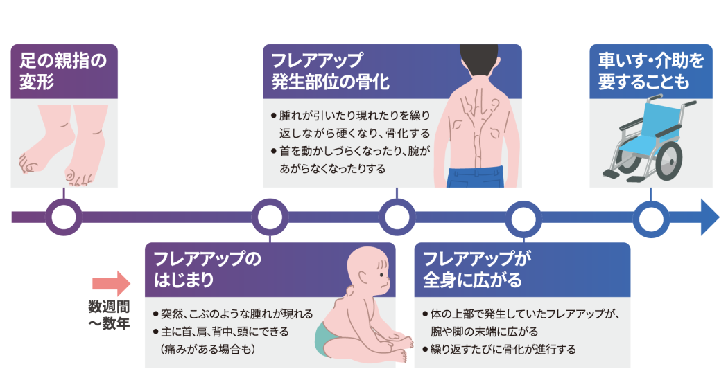 FOPの症状進行を示すタイムライン。足の親指の変形から始まり、数週間〜数年を経てフレアアップが開始。首、肩、背中の腫れや骨化が徐々に進行し、最終的に全身へ広がり車椅子や介助を要する状態になるまでのプロセスを示しています。