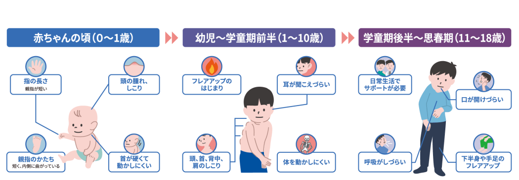 年齢とともに変化するFOPの主な症状。0〜1歳：手足の親指の変形、頭の腫れやしこり、首が硬くて動かしにくいなど。1〜10歳：フレアアップの開始。頭・首・背中・肩のしこり、体を動かしにくい、耳が聞こえづらいなど。11〜18歳：日常生活でサポートが必要。呼吸がしづらい、口が開けづらい、下半身や手足のフレアアップなど。